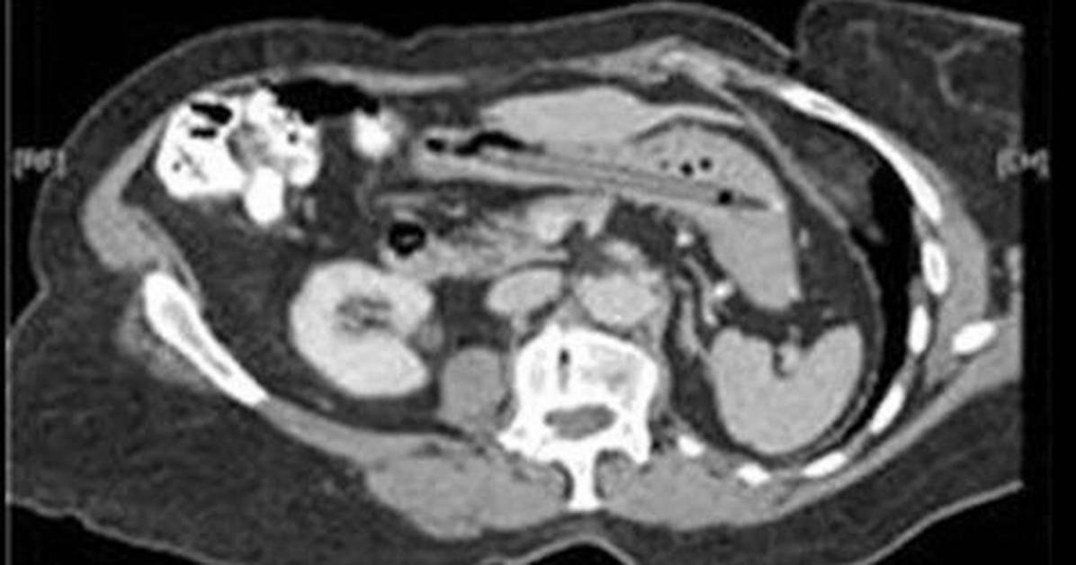 Doctors Discover Snake in Woman’s Stomach After Thinking She Was Pregnant