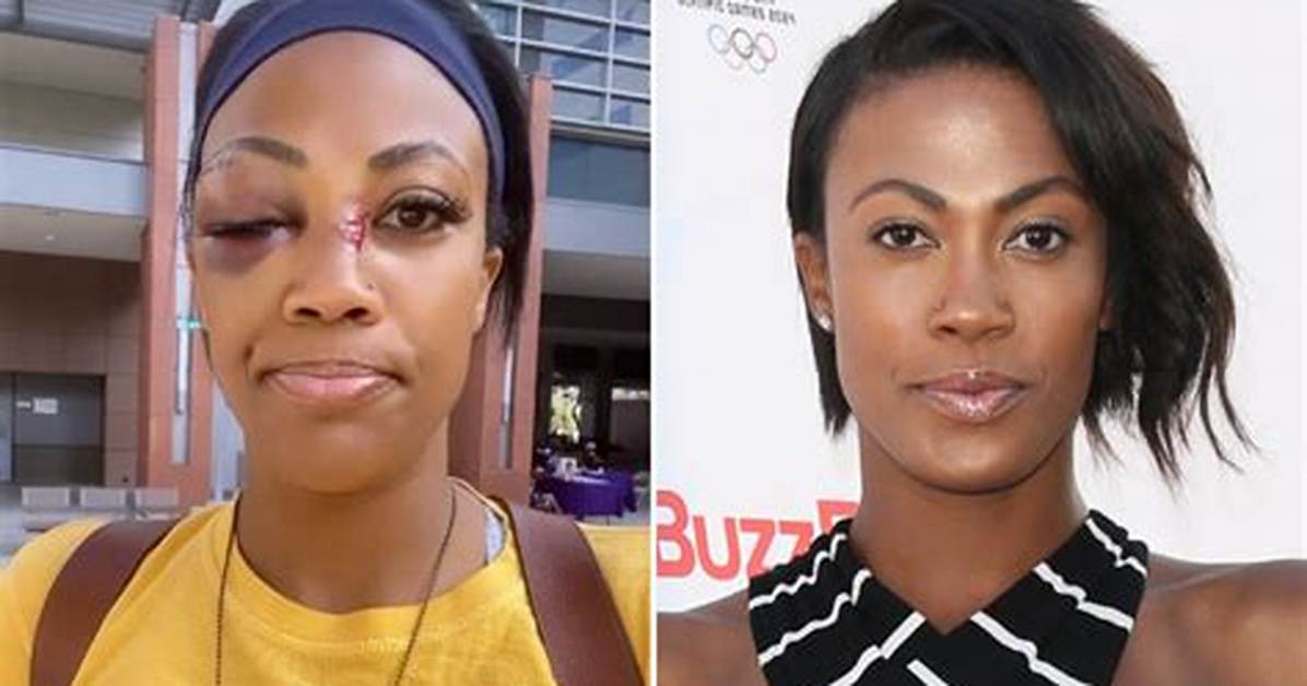 It Happened So Fast – Olympian Kim Glass Shares Injuries Inflicted by Homeless Man