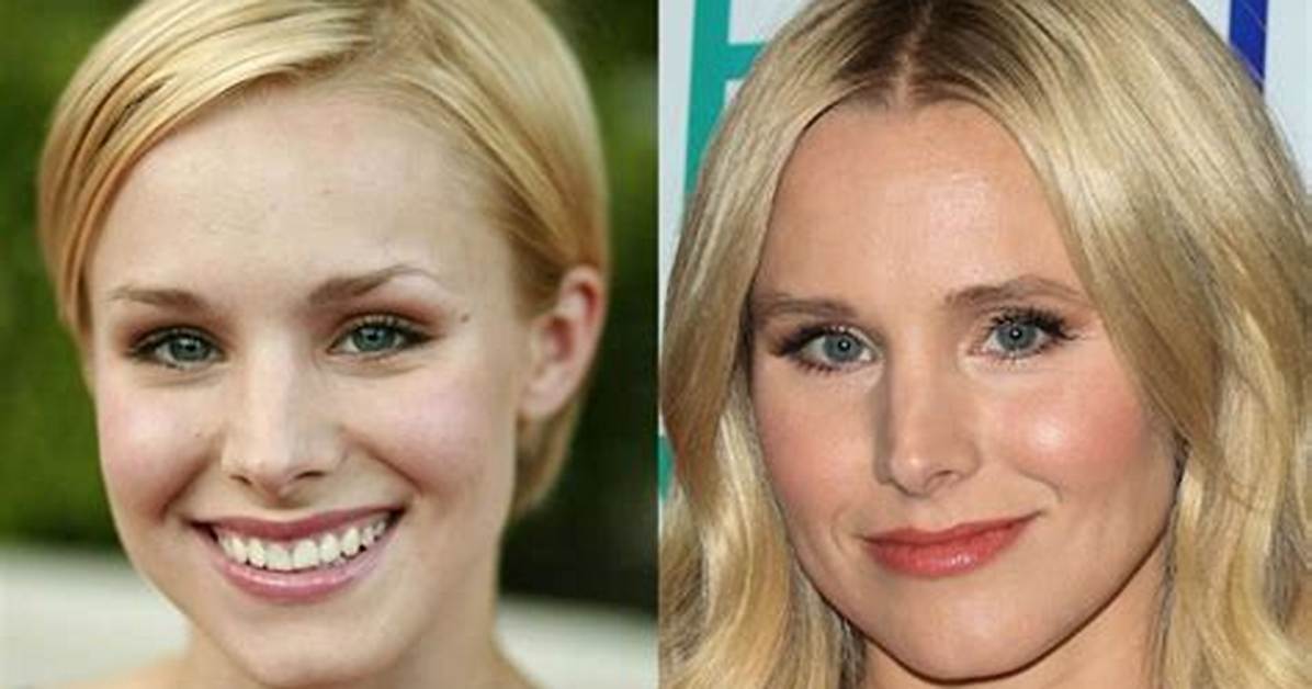 Kristen Bell Plastic Surgery Before and After