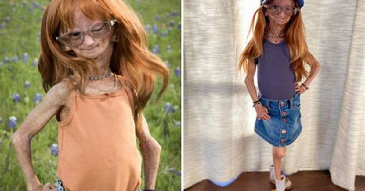 What Was Adalia Rose Williams Cause of Death?